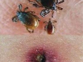 女子在公园被蜱虫咬伤 全身器官受感染